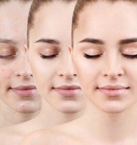 Bild von Microneedling Premium Ausbildung